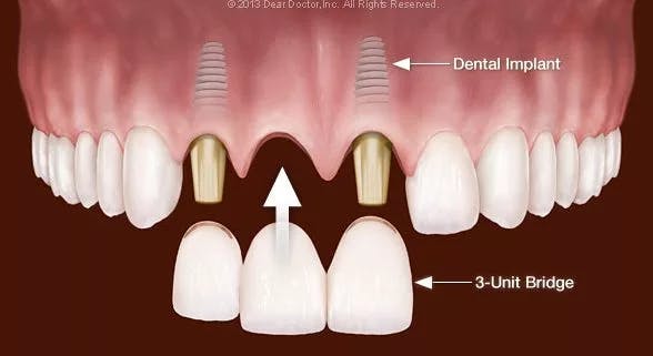 tooth bridge 