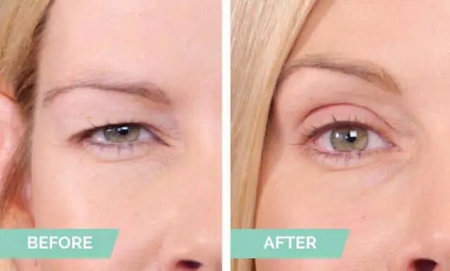 Eyelid Lifting 