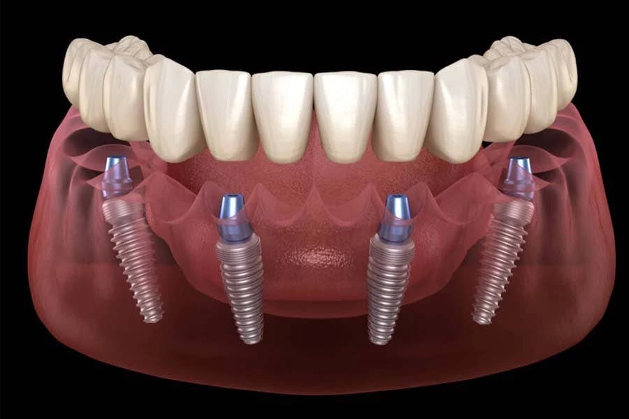 dental implant