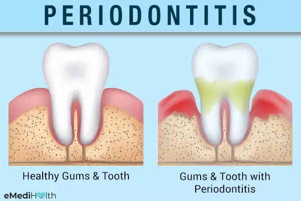 gingivitis 