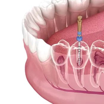 root canal 